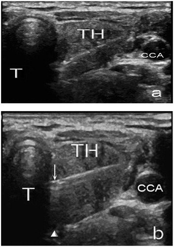 Figure 5. (a) Insertion of the microwave needle into the thyroid gland lesion; (b) Elevation of the microwave needle to separate the thyroid lesion from the dangerous triangle (↓, electrode needle; △: dangerous triangle; TH, thyroid; T, trachea; CCA, common carotid artery).