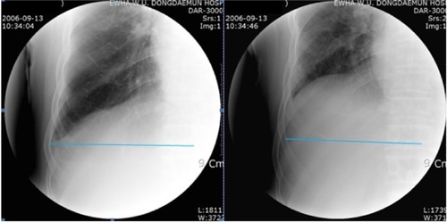 Figure 1 Radiographic image of the area displaced by diaphragm motion during inspiration and expiration for the same chronic obstructive pulmonary disease patient.Note: The thick horizontal lines of posteroanterior radiographs represent the costal insertion of diaphragm to the same spinal process of vertebral column between full inspiration and full expiration.