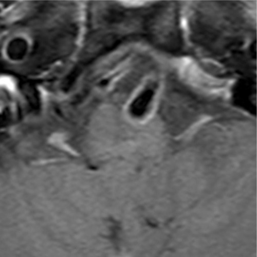Figure 6 MRI of the brain. Thin slice axial T1-weighted with gadolinium injection and fat suppression shows no gadolinium enhancement on compressed left medulla.