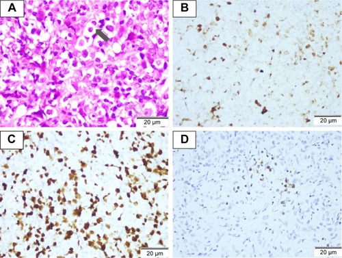 Figure 1 The results of swollen lymph node biopsy section. (A) Characteristic HRS cells exist in a mixed background of small lymphocytes, the arrow shows HRS cell (×1,000). (B) CD30 positive for lymphoma cells (×200). (C) MUM-1 positive for lymphoma cells (×200). (D) EBER was positive for lymphoma cells and was confirmed by in situ hybridization (×200).