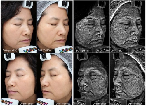 Figure 2 Macrophotographies taken under visible or UV light from one volunteer before and after vehicle cream or THBG cream application for 84 days.