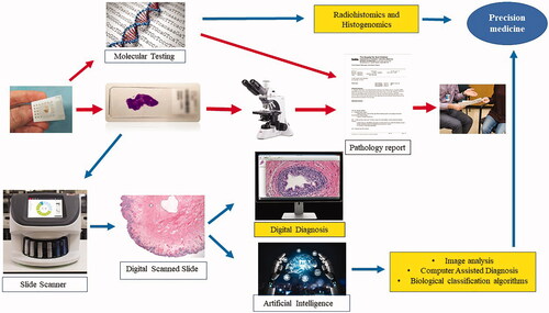 Figure 2. How disruptive innovation can revolutionize the workflow and outcome of pathology practice. The “classic” pathology workflow is indicated by the red arrows. The potential integration of image analysis and artificial intelligence is depicted by the blue arrows, and the potential added benefits of disruptive innovations are highlighted in yellow. In addition to creating a lenient workflow, image analysis can be an excellent tool for computer-assisted diagnosis by providing information beyond what the human eye can achieve. It can also create diagnostic algorithms to further classify disease into meaningful biological categories (prognostic and predictive). Eventually, the integration of molecular results and other diagnostic parameters (e.g. radiology and genomic data) will lead to enhanced precision diagnostics.