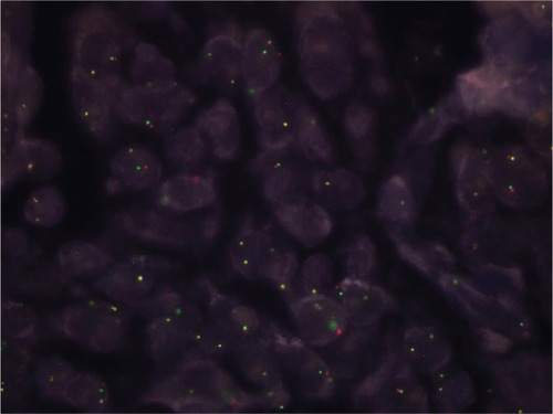 Figure 4 ALK gene rearrangement by FISH in the case of lung adenocarcinoma with positivity in 31% of neoplastic cells. FISH, ZytoLight SPEC ALK dual color, break apart probe (ZytoVision GmbH).
