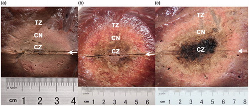 Figure 5. Longitudinal macroscopic features of the ablation zones in ex vivo porcine livers after radiofrequency ablation (RFA), by perfusion group. (a) Ablation zone after saline-perfused RFA at 103 °C, 30 W, and 30 min, ellipsoid-shaped, measuring 3.8 cm ×2.1 cm; (b) ablation zone after 10% HCl-perfused RFA at 103 °C, 30 W, and 30 min, spherical-shaped, measuring 6.8 cm ×5.5 cm; (c) Ablation zone after 10% HCl-perfused RFA at 103 °C, 60 W, and 30 min, spherical-shaped, measuring 7.3 cm ×6.8 cm. With the saline perfusate (a), the longitudinal electrode path (arrow) was surrounded by a narrow, black carbonised belt, whereas with the HCl perfusates (b, c), the electrode paths (arrows) were surrounded by wider belts that appeared moist sediment.