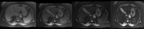 Figure 2 MRI 1.5 T (Siemens Avanto), using multi-TE gradient echo T2* MRI technique (using Garbowski method). Liver intensity is normal seen with the longest TE (14.68 msec). T2* =7.4 ms, corresponding to < 5 mg Iron/ g liver dry weight.