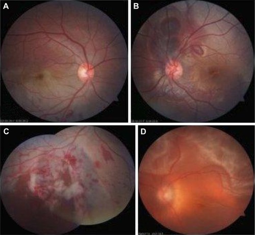 Figure 5 Blunt trauma-related retinal injuries: (A) commotio retinae, (B) choroidal tear with subretinal hemorrhage, (C) badly lacerated retina, and (D) retinal detachment.