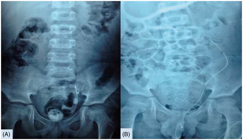 Figure 2. (A) KUB radiograph appearance of left lower ureteral stone and part in the bladder of forgotten severe encruste DJ stent for 41-month. (B) Severe encruste distal part of DJS and left lower ureteral stone were removed after PCCL and URS combine endourologic treatment.