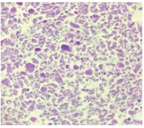 Figure 3. Periodic acid-Schiff (PAS) stain of the right bronchial middle lobe lavage cell block (100× magnification) showing few pulmonary macrophages in a background of abundant PAS-positive proteinaceous material