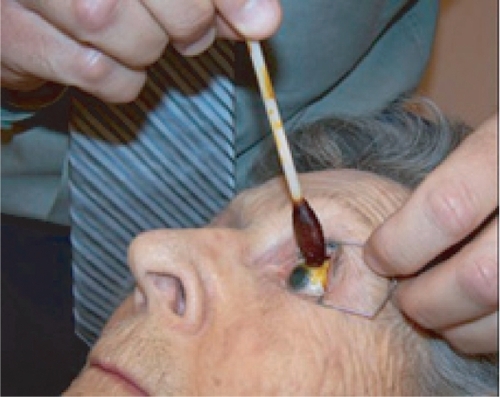 Figure 6b Povidone-iodine is applied to ocular surface for sterile preparation.