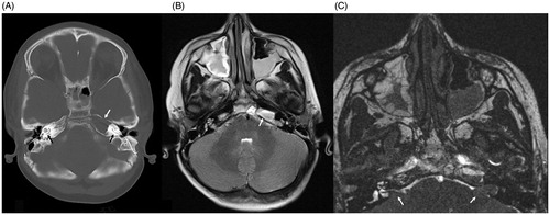 Figure 2. Pre-operative axial CT scan showing bony defect in left petrous apex filled with fluid/soft tissue density material (white arrow). Also seen are bilateral cochlear implant electrodes in place (black arrows) (A), axial T2-weighted MRI showing fluid and soft tissue in the left petrous apex (white arrow) (B), axial CISS MRI showing fluid and soft tissue in the left petrous apex. Cerebellar flocculus can be seen protruding into the internal acoustic meatus as a consequence of severe CSF hypotension (white arrows) (C). Note: MRI images do not have characteristic magnetic artifact because magnets have been removed from the internal cochlear receiver stimulator.
