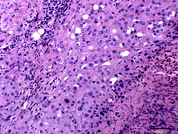 Figure 1. Mammary gland of a Sika deer with a comedocarcinoma composed of sheets of large pleomorphic polygonal cells in a fine fibrovascular stroma with marked necrosis and mild lymphocyte infiltration; haematoxylin & eosin. Bar = 25 μm.