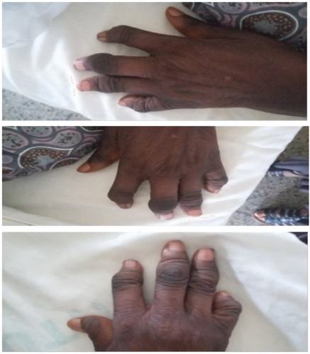 Figure 1 Arthritis mutilans of both hands.