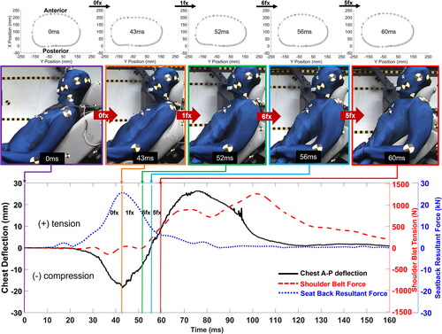 Figure 4. An exemplar chest contour, AP chest deflection, seatback resultant load, and shoulder belt tension time histories with respect to PMHS motion and the accumulation of rib fractures (PMHS05 in ABTS45).