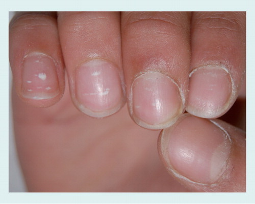 Figure 14. Punctate leukonychia in the fingernails of an 8-year-old boy: small white spots within the nail plate that has a normal surface.