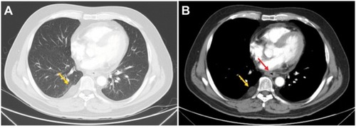 Figure 4 Variations in CT in the ESCC 1 month after finishing all the treatments.Note: (A and B) The stabilization of the right pleural mass (yellow arrows) and decrease of the thickened esophageal wall (red arrow) after the treatment, respectively.Abbreviations: CT, computed tomography; ESCC, esophageal squamous cell carcinoma.