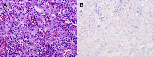 Figure 5 Pathological staining of right ankle joint effusion and inflammatory tissue. (A) Inflammatory cell infiltration was seen by HE staining. (B) Acid-fast staining was negative.