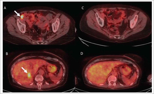 Figure 4. Example of responses in radiated and non-radiated zones in a patient of the “late radiotherapy” group. Fig. 4 shows representative images from (18)F-labeled fluorodeoxyglucose-positron emission tomography (FDG-PET) scans from patient #11. She had widespread in transit metastases on the right lower limb that had progressed on BRAF inhibitor monotherapy (vemurafenib). Despite switching treatment to nivolumab monotherapy for 4.5 months, lesions continued to progress on iliac nodes (panel A, arrow), lung and liver (panel B, arrow). Four sessions of 6 Gy were delivered to two adjacent metastatic iliac lymph nodes without withdrawing nivolumab treatment. All radiated (panel C) and non-radiated in-transit, lungs and liver (panel D) metastases had disappeared on PET-CT-scans performed 12 m after radiation. Nivolumab was discontinued, and the patient remained disease-free 6 months later.