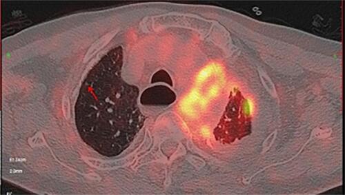 Figure 4 PET-CT suggests thickening and calcification of the pleura on both sides, increased FDG metabolism, more pronounced on the left.