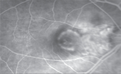 Figure 1 Before PDT, fluorescein angiography shows a predominantly classic subfoveal CNV.