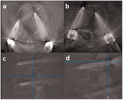 Figure 4. Pedicle screw assessment in the postoperative CT scans. (A) left grade 1 medial encroachment (B) right grade 2 lateral encroachment (C) upper screw with grade 1 cranial encroachment (D) lower screw with grade 1 caudal encroachment.