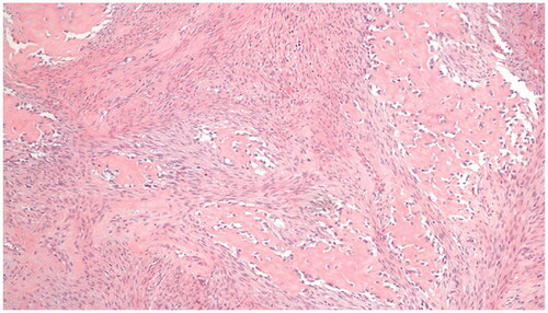 Figure 5. Fibro-osseous pseudotumor of digits. At medium power, the mixture of arranged fibroblasts and myofibroblasts and the deposits of osteoid is rimmed by uniform osteoblasts. Hematoxylin-eosin × 100.