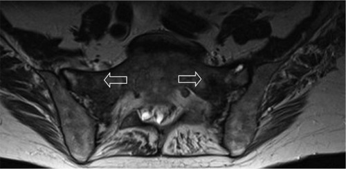 Figure 2 Axial T1-weighted MRI image of sacrum.