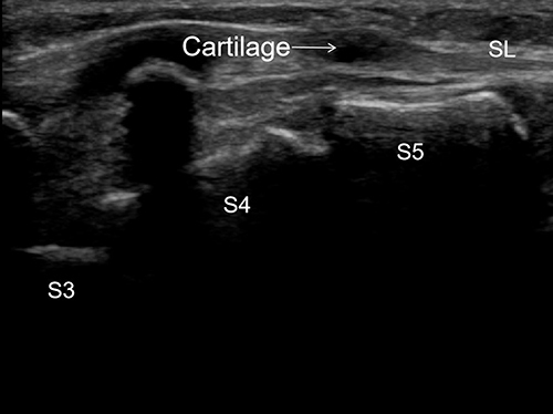 Figure 3 The sacral hiatus was covered by cartilage.