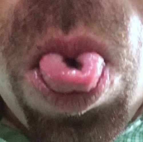 Figure 2. Rolling Tongue.