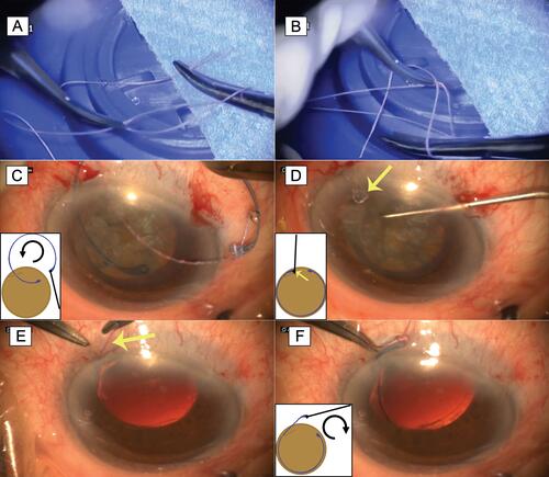 Figure 1 (A) Passing of the thread at one end of the capsular tension ring and hanging of the suture with a knot. (B) Counter knot. (C) Placing the ring in the capsular bag under the anterior capsulorhexis, by a counterclockwise movement. (D) Capsular ring in place. The knot is placed inside, under the iris (yellow arrow) and the thread emerges through the incision. (E and F) Removal of the tension ring by pulling of the thread protruding from the incision (yellow arrow) clockwise.