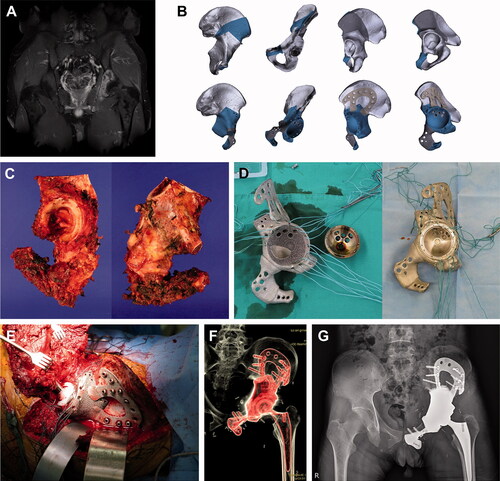 Figure 1. Pelvic reconstruction. Images of patient #5. (A) A preoperative gadolinium enhanced T1-weighted MR image showing Ewing sarcoma arising from the left acetabulum. (B) Graphical designs of the 3D-printed bone tumor resection guide (upper row) and implant (lower row). (C) Resected bone tumor as planned. Photographs of the (D) 3D-printed implant and THA cup before (left) and after conjugation (right). (E) Intraoperative photograph, (F) postoperative CT reconstruction image, and (G) plain radiograph showing pelvic reconstruction.