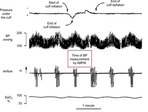 Figure 4 Fragment of a polygraph recording in a representative sleepy patient with severe obstructive sleep apnea.