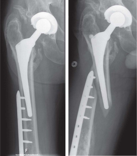 Figure 2. Three patients were reoperated due to failure of fixation. All 3 had experienced a new low-energy fall, with a fracture occurring at the stress-rising area where there was overlap between the plate and the prosthesis.