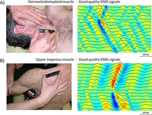 Figure 3. Examples of sEMG signals of good quality from two different muscles. (A) Signal recorded from Sterno Cleido Mastoid muscle, where it is possible to recognize the IZ (between channel 4 and 5). (B) Signal recorded from upper trapezius muscle, where IZ is visible on channel 9.