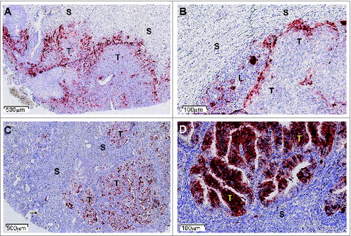 Figure 1. IDO1 Protein expression in human tumors assessed by immunohistochemistry. Illustrative images from formalin-fixed paraffin-embedded tissue microarray sections of cervical (A, B) and endometrial carcinomas (C, D) stained with the anti-IDO1 antibody 4.16H1. Tumoral (T), stromal (S), and lymphocyte-enriched (L) areas are indicated. Immunolabeled cells are stained dark red.