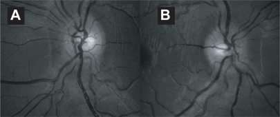 Figure 2 An 11 year old boy with sudden onset of visual loss 2 weeks following a viral upper respiratory tract infection. Bilateral disc swelling was seen in the right (A) and left (B) disc. Visual acuity improved over 1 week spontaneously from counting fingers to 20/20 in both eyes.