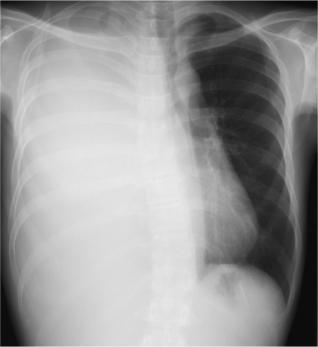 Figure 1 Chest radiography showing complete opacity of the right lung with a shifted mediastinum to the left.
