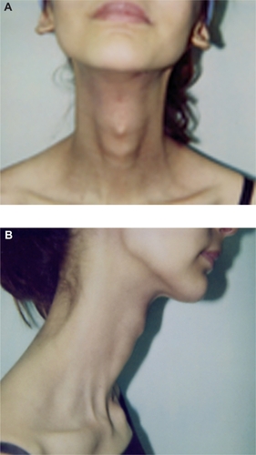 Figure 4 Soft tissue fibrosis of the neck in frontal (A) and lateral (B) views immediately after treatment with chemoradiotherapy.