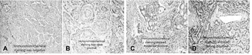 Figure 1 PD-L1 respective immunohistochemical staining of different types of lung cancer-from left to right are negative, weak, moderate and strong expression. (A) Immunohistochemical staining was negative; (B) Immunohistochemical staining was weak positive; (C) Immunohistochemical staining showed moderate positive; (D) Immunohistochemical staining showed strong positive.