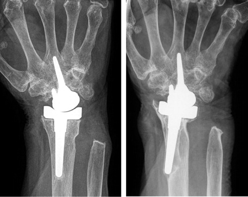 Figure 3. Left: 1 year postoperatively. Right: 5.5 years postoperatively showing severe loss of bone stock with migration, collapse, and breakthrough of the cortex of the radial component.