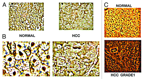 Figure 3. In situ identification of ZIP14 in normal liver vs. HCC. (A) ZIP14 IHC showing high transporter abundance in the normal hepatocytes and its loss in HCC hepatoma cells. (B) Higher magnification showing ZIP14 transporter localized to the normal hepatocyte plasma membrane, and the absence of plasma membrane transporter in the hepatoma cells. (C) In situ RT-PCR showing high expression of ZIP14 in normal hepatocytes, and silencing of expression in the well-differentiated Grade 1 hepatoma cells. (Taken and modified from ref. Citation14.)