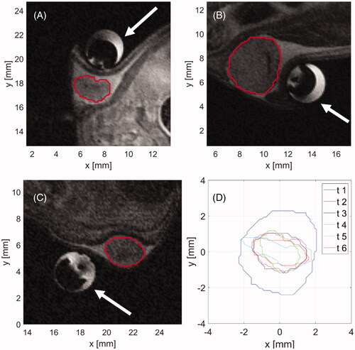 Figure 4. Example (A–C) anatomic MR images of subcutaneously implanted HAC15 tumors (red contour) and the microwave ablation applicator (white arrow). The boundaries of all six treated tumors (D) in a central axial plane through the tumor.