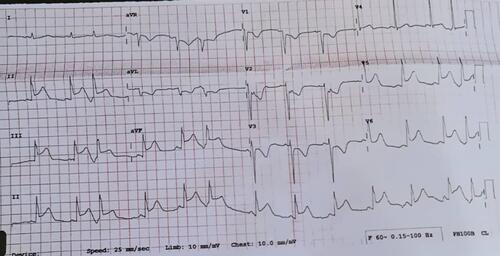 Figure 1 ECG showing inferolateral elevation myocardial infarction.
