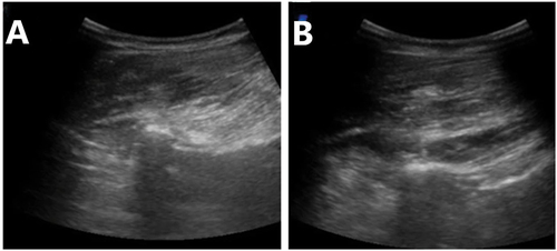 Figure 2. Ultrasound guided lumbar erector spinae plane block.