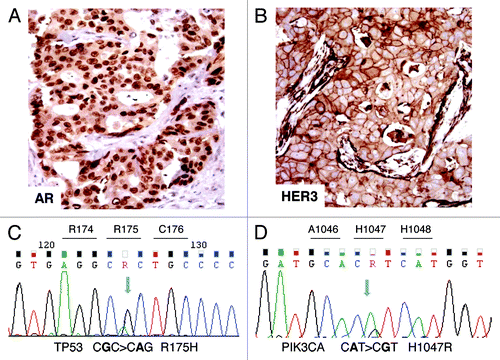 Figure 2. Immunohistochemical and molecular analyses. (A) AR-positive immunostaining in tumor nuclei. (B) HER3-positive membrane and cytoplasm immunostaining. (C) Case 1: electropherogram of TP53 mutation analysis showing the missense mutation R175H in exon 5. (D) Case 2: electropherogram of PIK3CA mutation analysis showing the missense mutation H1047R in the kinase domain (exon 20).