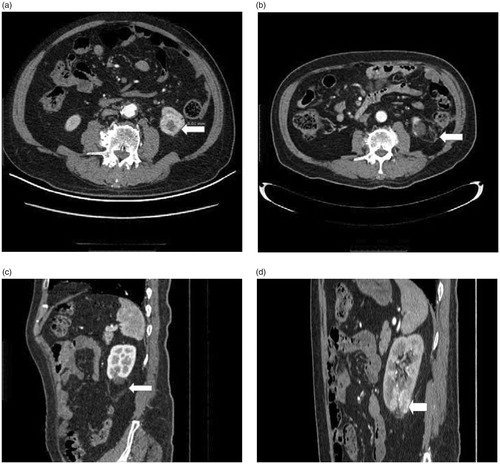 Figure 4. (a) Axial contrast-enhanced CT image shows exophytic 2.6 cm clear cell RCC (arrow) located in dangerous location (The edge of the tumor is 0.5 cm from bowel). (b) (c) Axial and sagittal contrast-enhanced CT image shows no enhancement for nodular areas after US-guided percutaneous MWA. (d) sagittal contrast-enhanced CT image obtained 29 months after MWA. A LTP nodular occurred in the above of the ablation area.