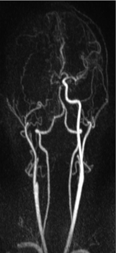 Figure 4 Post processing MRA of the neck shows right internal carotid artery occlusion from the origin.