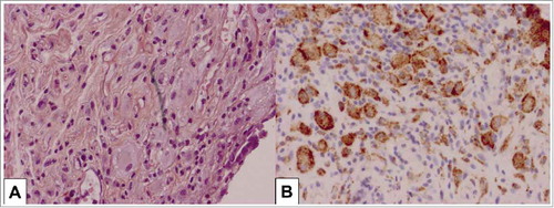 Figure 2. Pathologic features of appendicular/mesenteric tissues in Erdheim-Chester disease involvement. Tissue infiltration by pathologic histiocytes with foamy cytoplasm: H&E x 400 (A) and CD68 staining x400 (B).