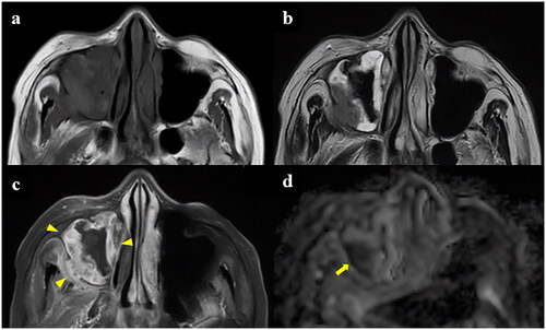 Figure 2. (a) Magnetic resonance imaging showing a hypo-intense signal at the center of the right maxillary sinus and an intermediate signal intensity at the posterior of the posterior wall of the maxillary sinus on T1-weighted imaging (T1WI). (b) T2-weighted imaging shows a significant hypo-intense signal at the center of the right maxillary sinus. Maxillary mucosa showed substantial contrast between the hypo-intense signal at the posterior wall and the hyper-intense signal in the rest of the maxillary sinus. (c) Gadolinium-enhanced fat-suppression T1WI shows that the entire maxillary sinus mucosa and pterygopalatine fossa were enhanced (arrowhead). (d) in contrast, the decrease in the apparent diffusion coefficient was limited to a portion of the posterior wall of the maxillary sinus (arrow), while the rest of the maxillary mucosa and pterygopalatine fossa was not enhanced.