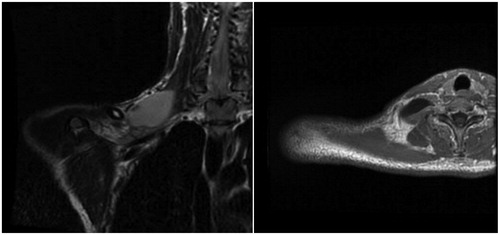 Figure 4. Patient’s magnetic resonance image showing a pseudomeningocele at C7 level. Coronal view on the left; axial view on the right.