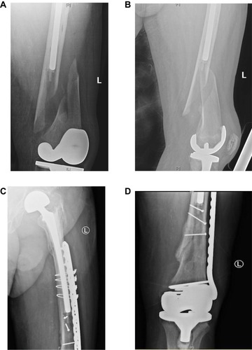 Figure 2 Preoperative radiographs (A, B) demonstrating a long spiral oblique interprosthetic fracture with apex posterior angulation. A laterally based femoral locking plate was used for internal fixation of this fracture (C, D) with the addition of interfragmentary lag and position screws.